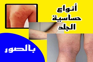 أنواع حساسية الجلد بالصور دليل شامل