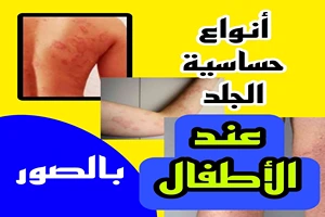 أنواع شائعة لحساسية الجلد عند الأطفال