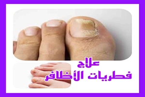 علاج فطريات الأظافر