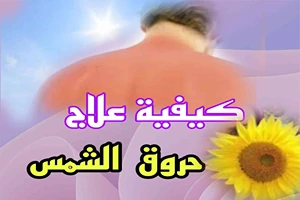 كيفية علاج حروق الشمس