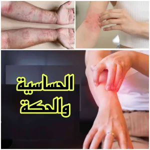 علاج فعال للحساسية والحكة.. كيف تنهي معاناتك سريعاً